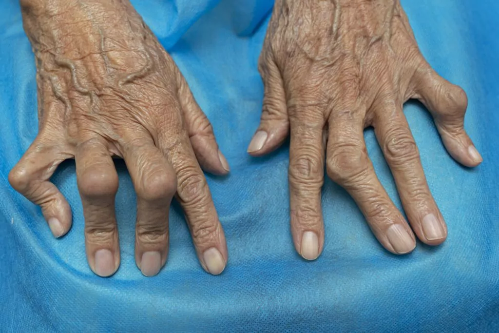 Do I have Rheumatoid Arthritis ?